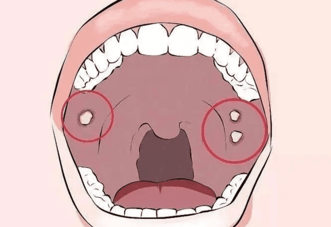 口腔癌分期​