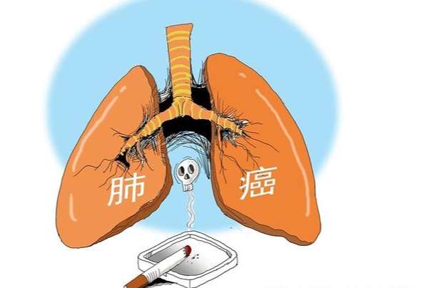 肺癌前兆