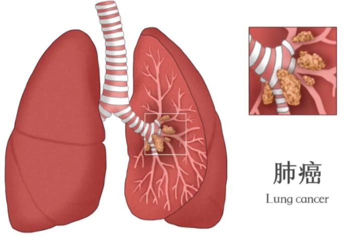 肺癌是怎麼引起的 肺癌是怎麼引起的