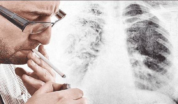 肺腺癌治疗 肺腺癌治疗