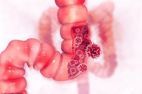 大腸癌存活率 大腸癌存活率