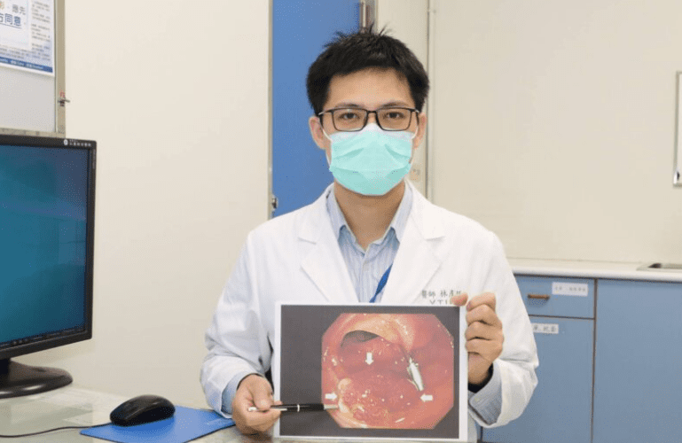 大腸癌治療 大腸癌治療